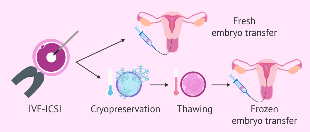 Frozen Embryo Transfer