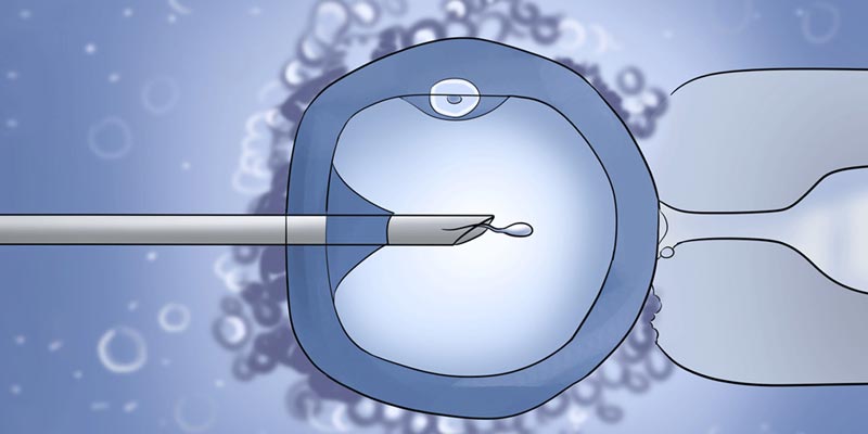 Intracytoplasmic Sperm Injection Procedure